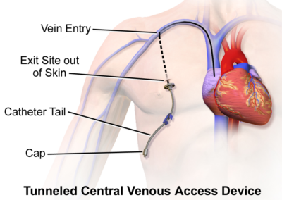 Central Venous Access Device (Tunneled)