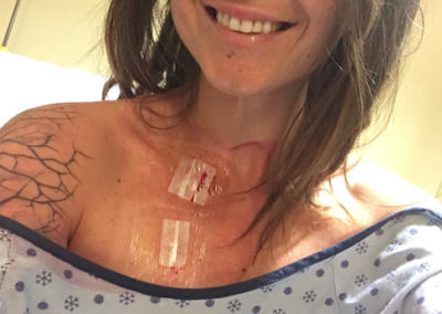 removal of IV central line